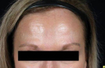 Botox - Case #8 After